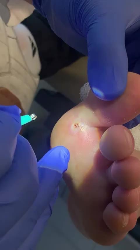 SPORTS SOS | 충격의 빌바닥 가시 뽑기 ㄷㄷ 확인 필수