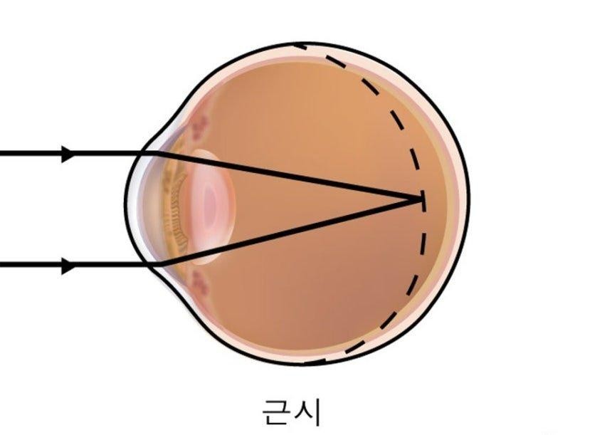 SPORTS SOS | 한국인 40세 이전 4명중 3명 '근시', "미국 유병률의 2배" 정보
