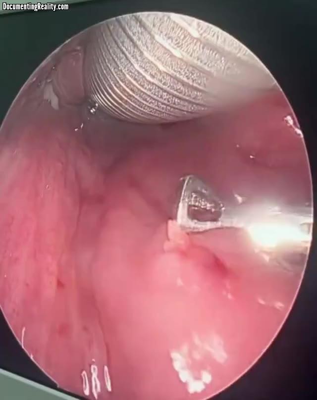 SPORTS SOS | 약혐) 한 달 전에 목에 박힌 생선 가시를 수면마취하고 제거 정보