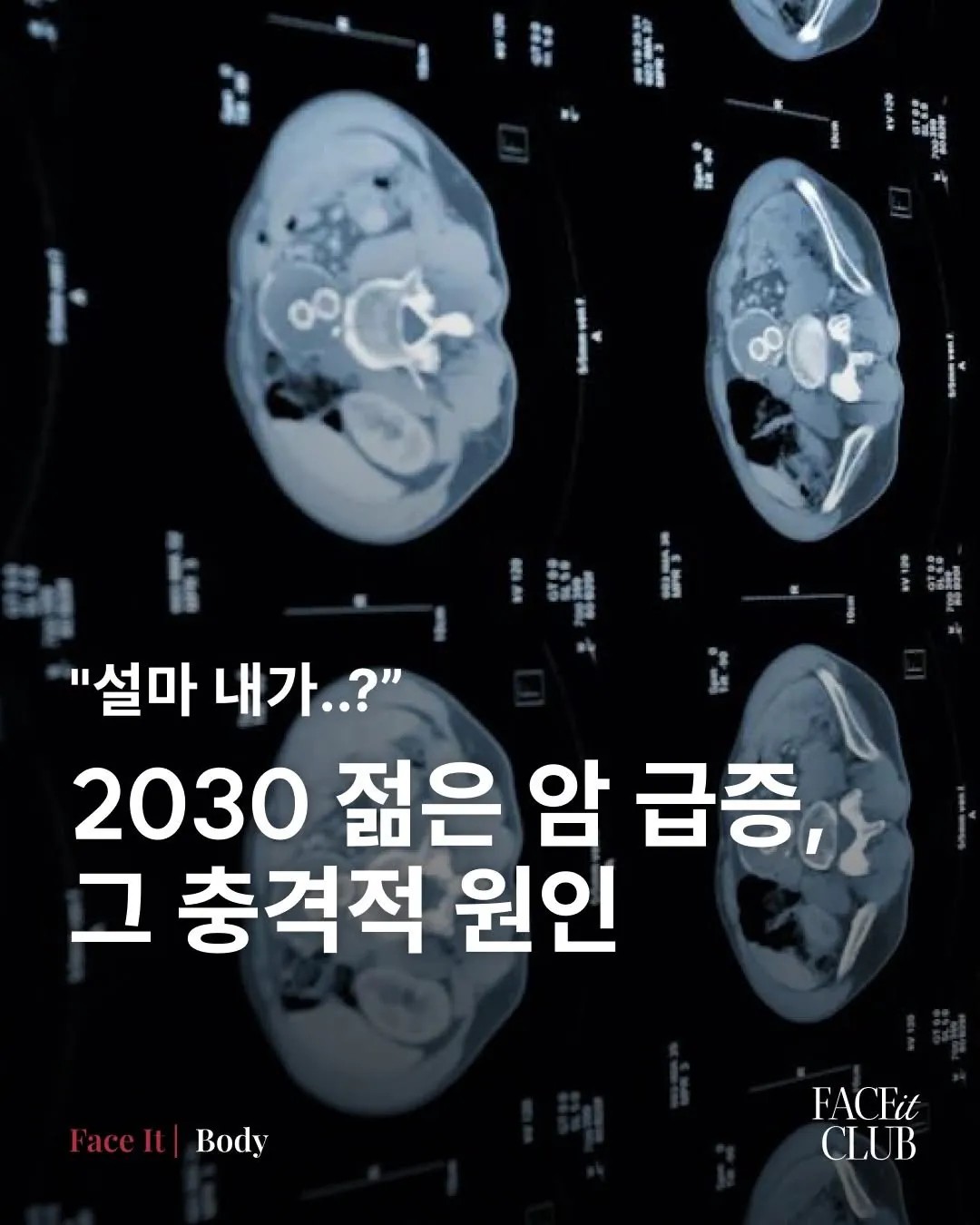 SPORTS SOS | 2030 젊은 암 급증, 그 충격적 원인 정보