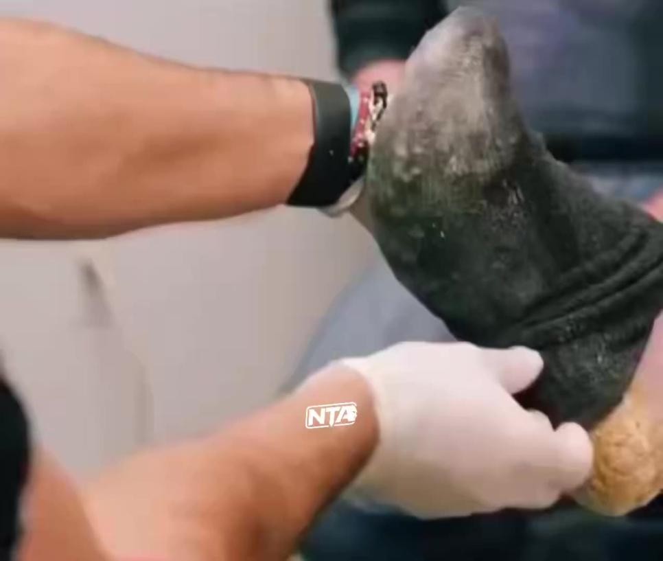 SPORTS SOS | 약혐) 20년간 발 굳은살 방치 ㄷㄷ..mp4