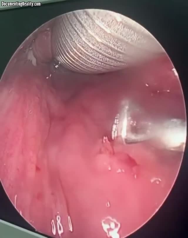 SPORTS SOS | 혐) 한 달 전에 목에 박힌 생선 가시를 수면마취하고 제거 [속보]